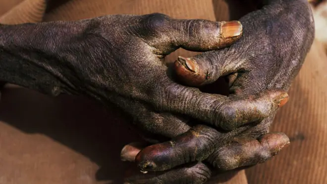 Ọwọ ti olootu rẹ papọ, ọwọ naa dudu, awọn eekanna rẹ si fi apẹẹrẹ wahala ṣiṣẹ han.