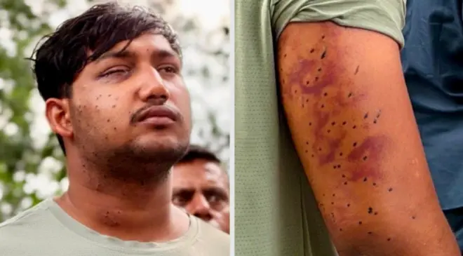 साहिल लोचब ( पत्रकार परिषदेवेळी त्याने आपल्या शरीरावर कुठे जखमा झाल्या हे सांगितले.)