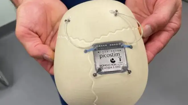 Aworan ẹrọ igbalode ti wọn fi n dena aisan warapa