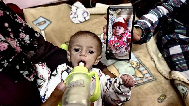5-month-old Siwar Ashoura, one of hundreds of children diagnosed with malnutrition, is being treated at Nasser Hospital in Khan Yunis, Gaza on May 1, 2025.