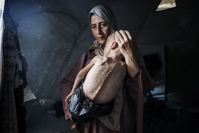 O bebê Muhammad e sua mãe em uma tenda em Gaza. Ele tem ossos aparentes e usa um saco plástico como fralda
