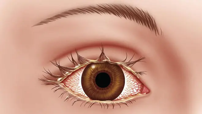 आँखा पाक्ने रोग