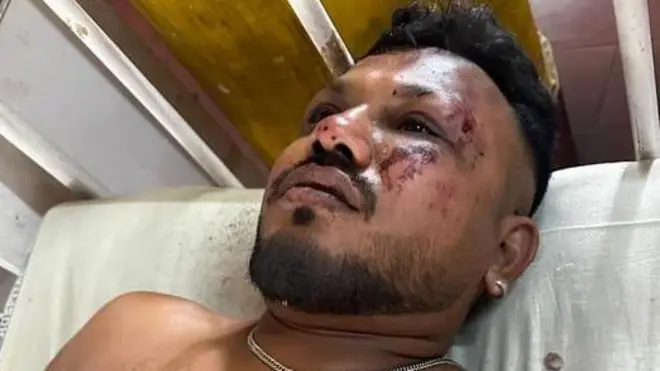 Vishwash Kumar Ramesh após acidente aéreo, com rosto ferido e marcas de sangue
