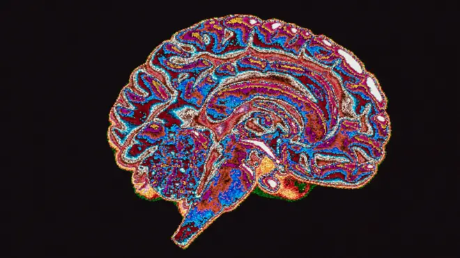 Resonancia magnética del cerebro.