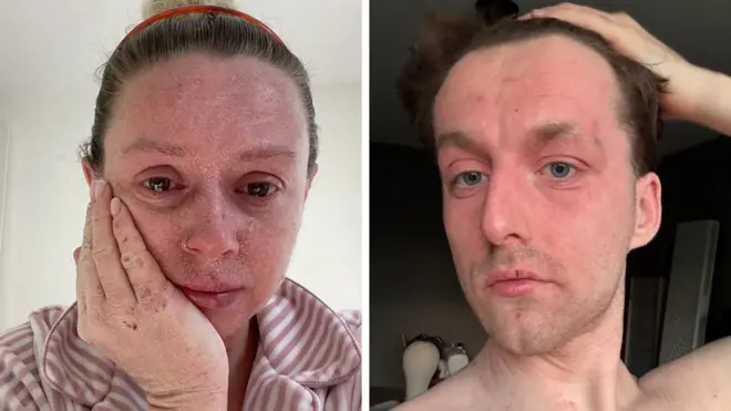 Two pictures of people with TSW. The left pic is of Rebecca and she has red, sore, peeling skin on her face. She is crying. The pic on the right is of Henry, he has a red face and he looks in pain