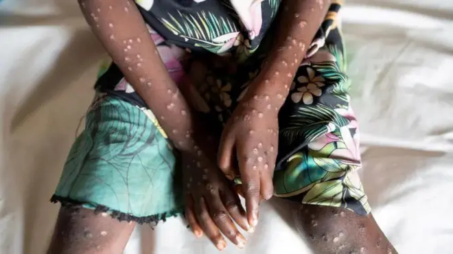 Milipuko nchini DR Congo imeathiri watoto pamoja na watu wazima