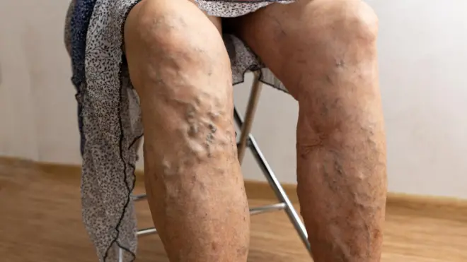 స్పైడర్ వెయిన్స్