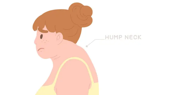 नेक हंप टाळायचा कसा?