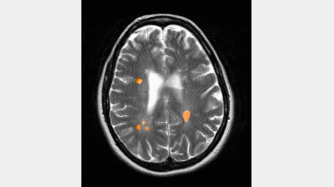 मल्टिपल स्क्लेरोसिस से पीड़ित 42 साल की एक महिला के दीमाग की एमआरआई