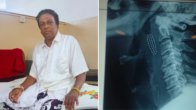 ශල්යකර්මයෙන් පසු ප්රේමලාල් රෝහල් ඇඳ මත වාඩි වී සිටින අයුරු