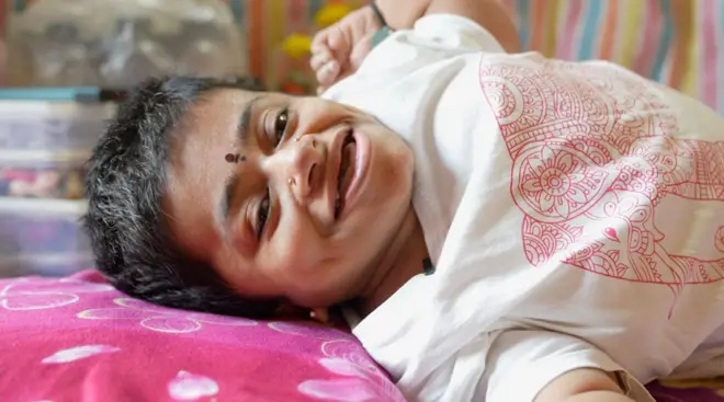 'ඔස්ටියෝජෙනසිස් ඉම්පර්ෆෙක්ටා' රෝගයෙන් පෙළෙන 29 හැවිරිදි ගිරිජා සිනහ සෙමින් සිටින අයුරු මෙහි දැක්වේ.