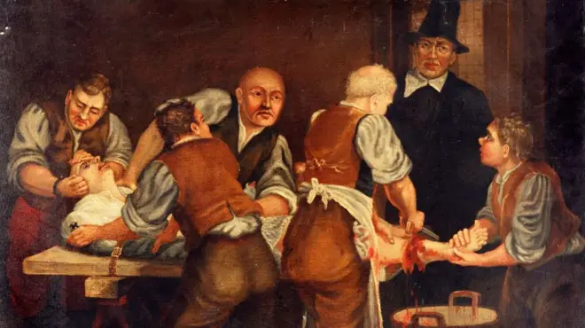 Un cirujano realizando una amputación de pierna en el siglo XVII. Óleo, siglo XIX