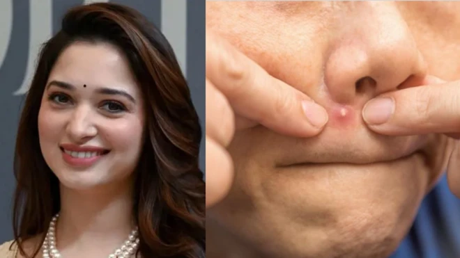 Tamannah Bhatia, Pimples