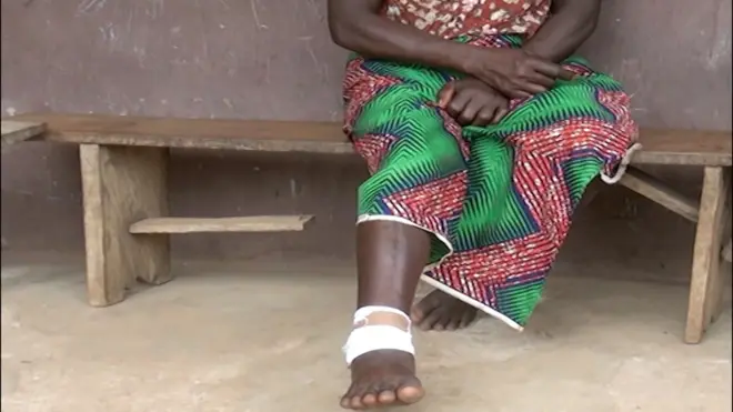 Foto wey dey show woman leg wey get injury