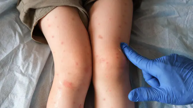 Un médico examina a un niño con sarampión