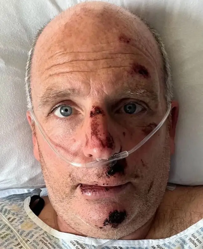 පාපැදි අනතුරෙන් පසු ග්ලෙන් සතියක් පමණ බරපතළ අනතුරු අංශයේ ප්‍රතිකාර ලැබීය