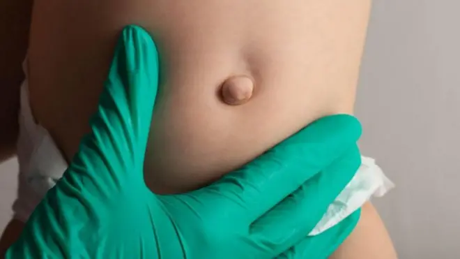 పుట్టుకతో వచ్చే హెర్నియా