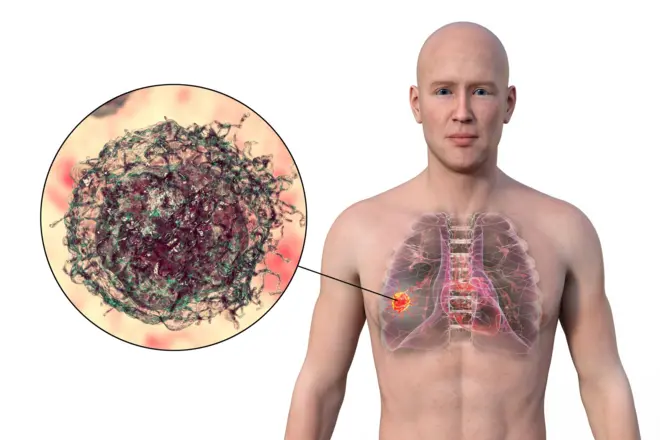 ‘मी आयुष्यात कधी सिगरेट ओढली नाही, मग मला कॅन्सर कसा झाला?'; जाणून घ्या फुफ्फुसाच्या कॅन्सरबद्दल सर्वकाही