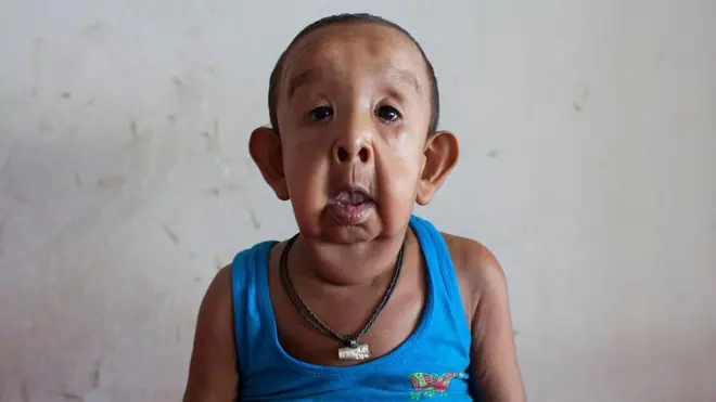 বায়জিদ শিকদার: চার বছর বয়সেই বৃদ্ধ মানুষের মতো উপসর্গ ছিল তার