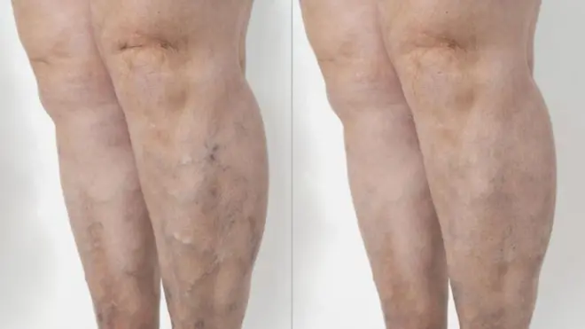 సిరల వాపు