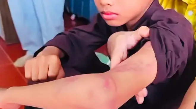 Một chú tiểu bị đánh bầm tím