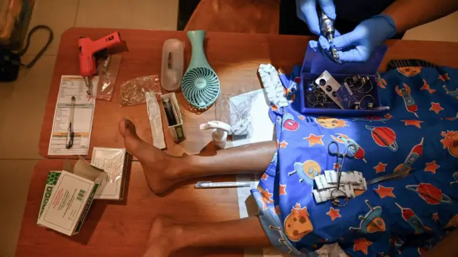 طبيب يستعد لختان طفل