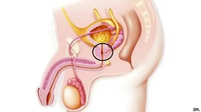 پروستات؛ آنچه هر مردی باید بداند