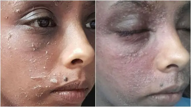 करिश्मा म्हणतात की टीएसडब्ल्यूची लक्षणं काळ्या किंवा सावळ्या त्वचेवर वेगळ्या प्रकारे दिसतात, त्यामुळे त्यांना टीएसडब्ल्यू झाला असल्याचं लक्षात यायला त्यांना थोडा वेळ लागला
