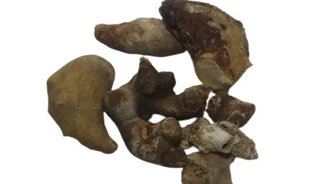 மான் கொம்பு வடிவில் சிறுநீரகத்தில் உருவாகும் கல்