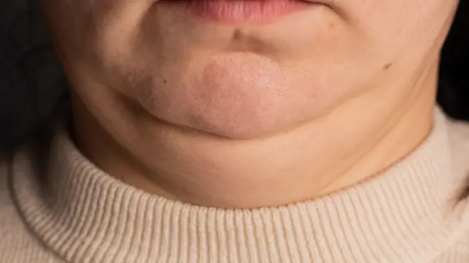 资料照片显示,一个人从下唇到颈底的皮肤状况,其颈部皮肤松弛,该人穿着一件乳白色圆领套头衫