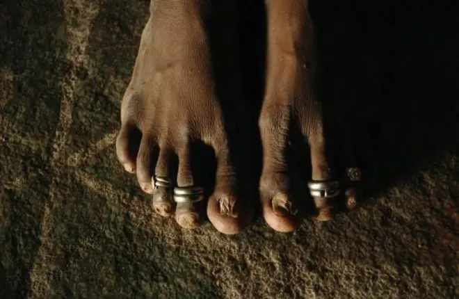 ANDHRA PRADESH, INDIA - AUGUST 23: Yellama, 31, wears toe rings which signify that she is married to the goddess she has been named after in her home in this photo taken on August 23, 2005 in Mehbubnagar, in Andhra Pradesh, India. She is a Jogini, or "servant of god" and was married off to the local deity when she was seven years old because her parents did not have a male child to support them . They believed it was better to keep her in their village and the only way to do this is to marry her to the goddess. After the cermony she is unable to marry any man and becomes the property of the men in the village. On the night of her initiation, after reaching puberty, the joginis are offered to an upper caste village elder or landlord. As months and years go by, most of the men in the village end up exploiting these girls. Jogini, Mathamma, Basiviin different regions of Andhra Pradesh they go by different names but they are all variations of a similar tradition of sexual exploitation of poor, illiterate Dalit women in the name of religion. The practice dates back some 2,000 years and is still deeply ingrained in the local Telangana culture. (Photo by Ami Vitale/Getty Images)