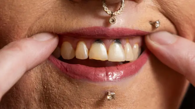 Stacey holds back her top lip with her index fingers showing white top teeth but with dark holes in her gums above the two front incisors . she has a diamond stud in her lower and upper lip and an ornate gold ring in her nose