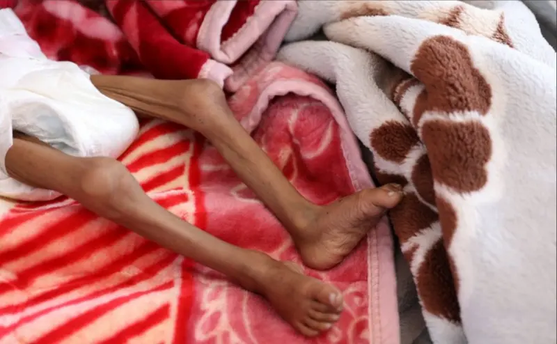 تظهر في الصورة قدما طفلة لونهما أسمر ونحيلتان جداً.