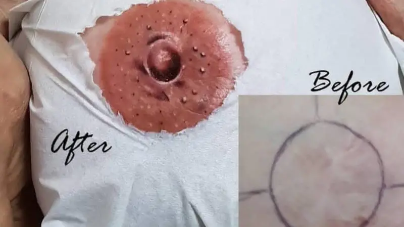 A woman's breast area tattooed to conceal the effects of a mastectomy.