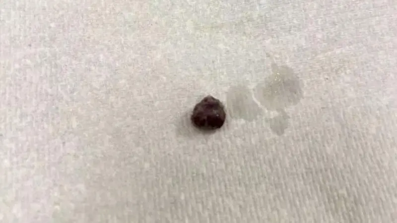 Small black ball - a rozinka removed from Peyton Handley's nose