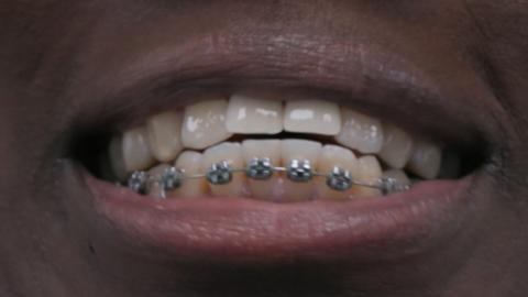 A close up of a woman's mouth, smiling and showing her braces on her bottom teeth.