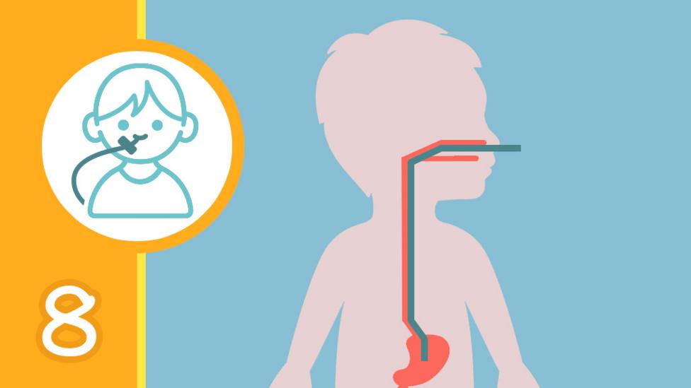 A diagram of a child's body with an Nasogastric tube running through the nose and into the stomach