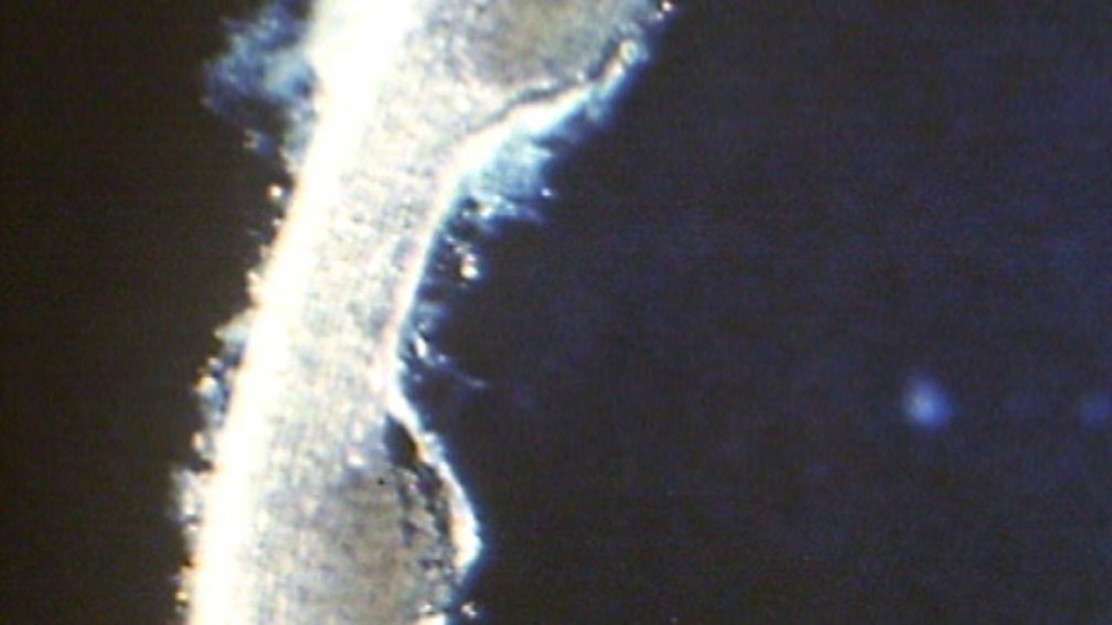 BBC Two Bitesize Biology, Kidney transplant