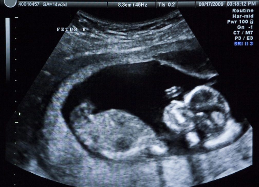 Ultrasound - Sound and ultrasound - Edexcel - GCSE Physics (Single