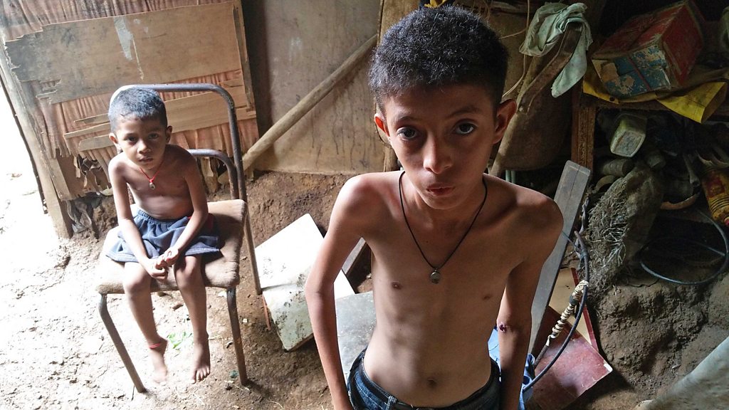 Exclusivo BBC Mundo: las impactantes imágenes que muestran el drama de la  severa desnutrición infantil en Venezuela - BBC News Mundo