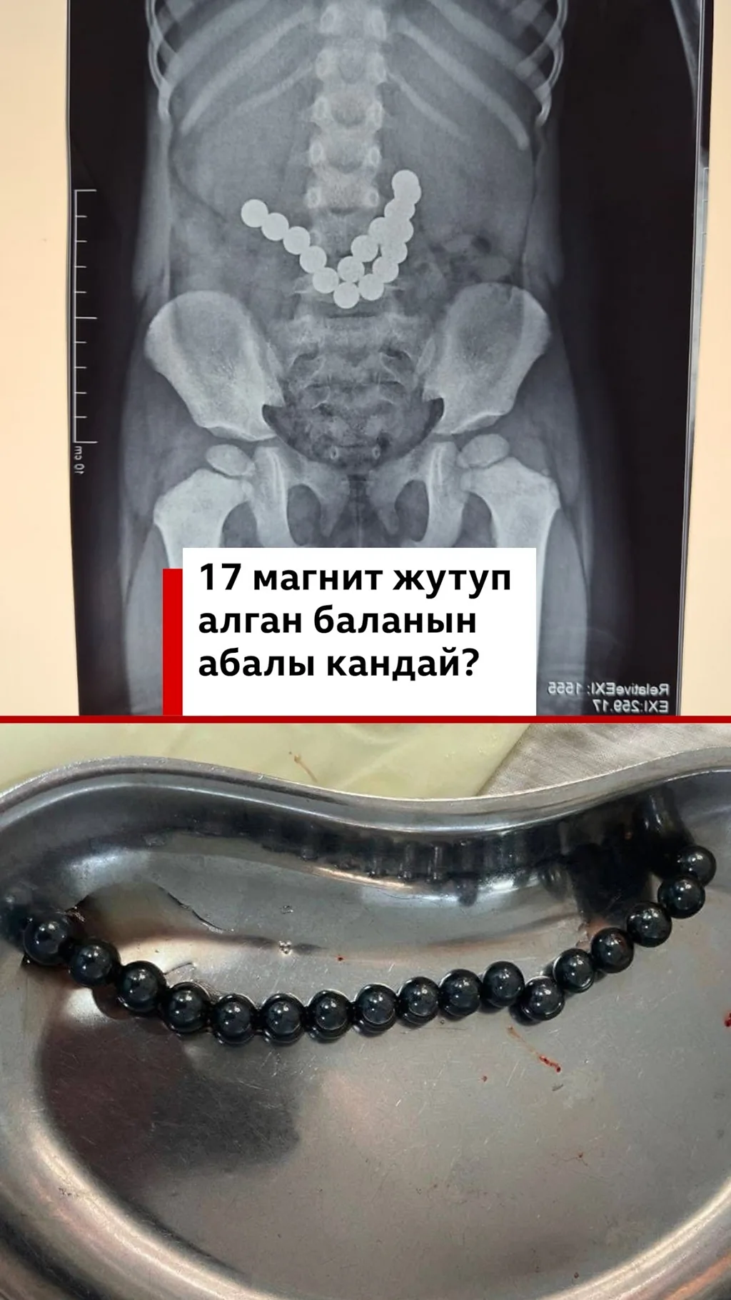 Ош облустар аралык балдар клиникалык ооруканасына 15-январь күнү эки жаштагы наристе түшкөн. Рентген жыйынтыгы баланын ичинде 17 даана магнит бар экенин көрсөткөн.