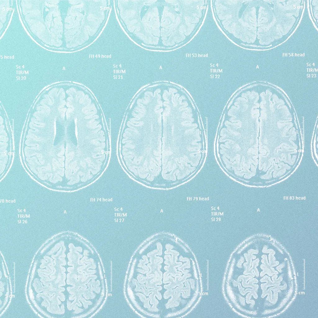 Better understanding of the basic science of migraines could one day inform better treatments (Credit: Serenity Strull/ Getty Images)
