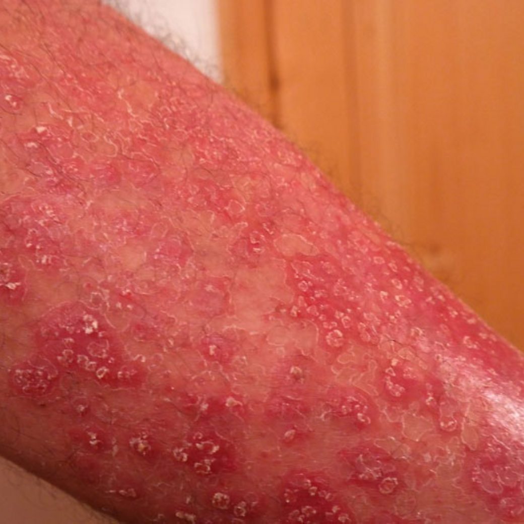 how to cure psoriasis permanently uk