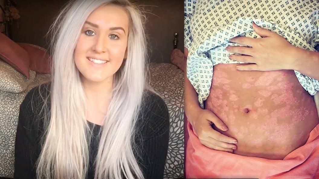 Bryony and the psoriasis she suffers with.