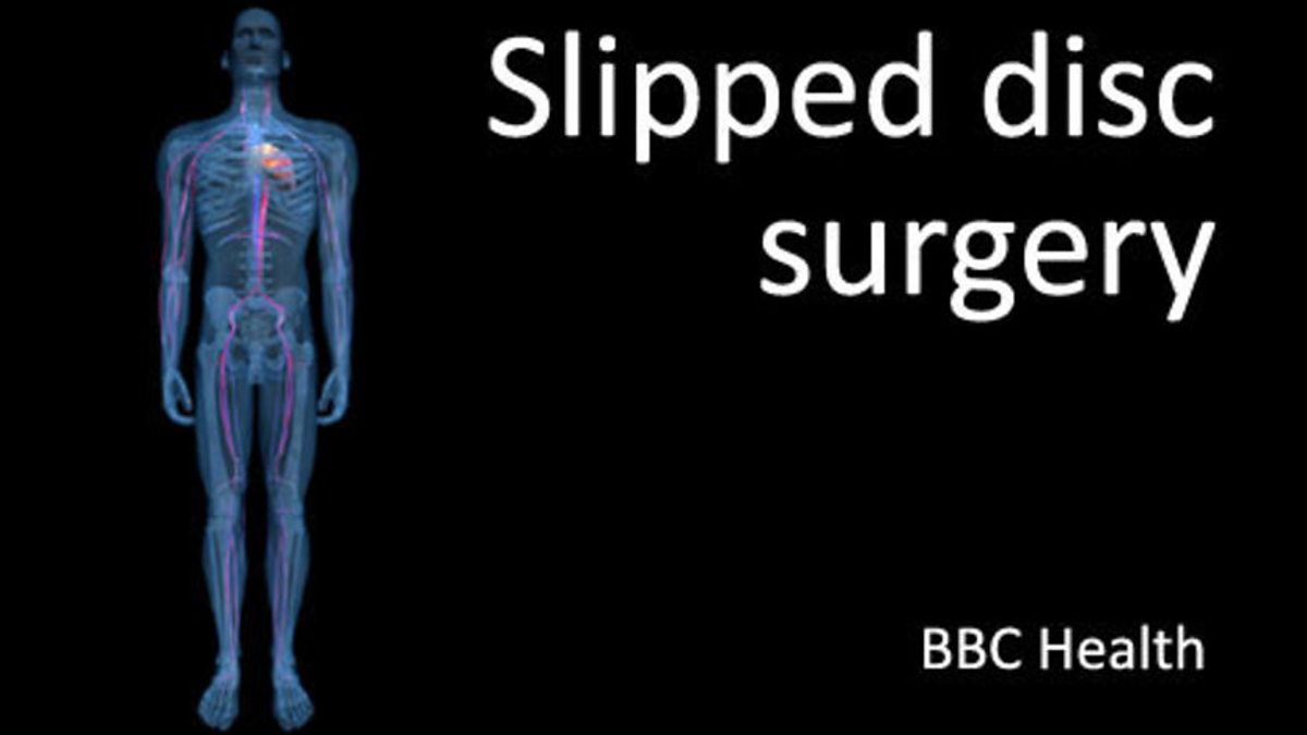 BBC BBC Health, Surgical procedures slipped disc surgery