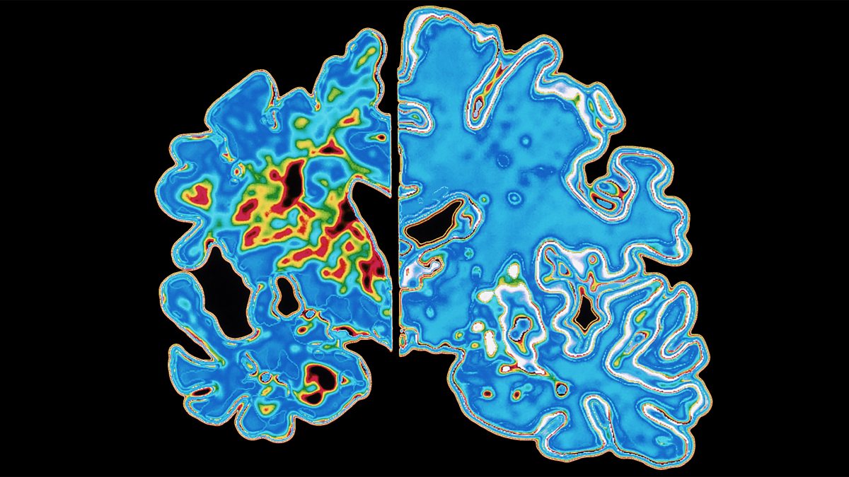 BBC World Service - The Science Hour, Alzheimer’s Research Drug Failure