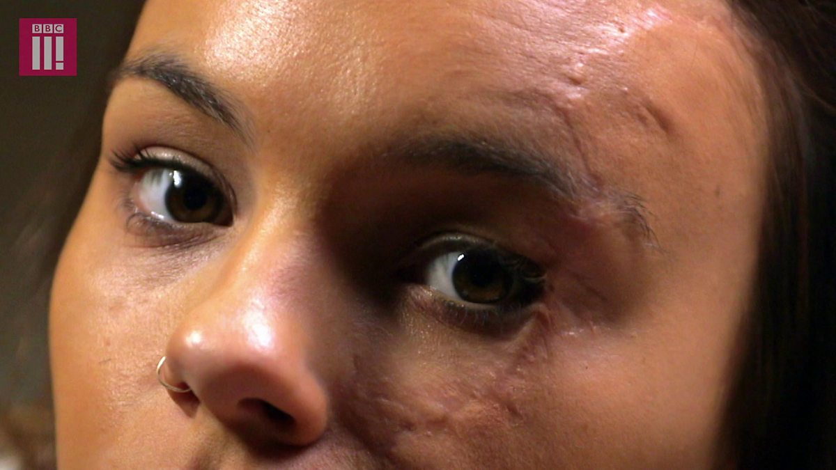 Can you learn to love your scarred face after a horrific car accident? 