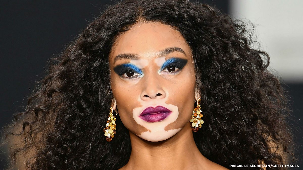 BBC World Service - BBC Minute, BBC Minute: On vitiligo