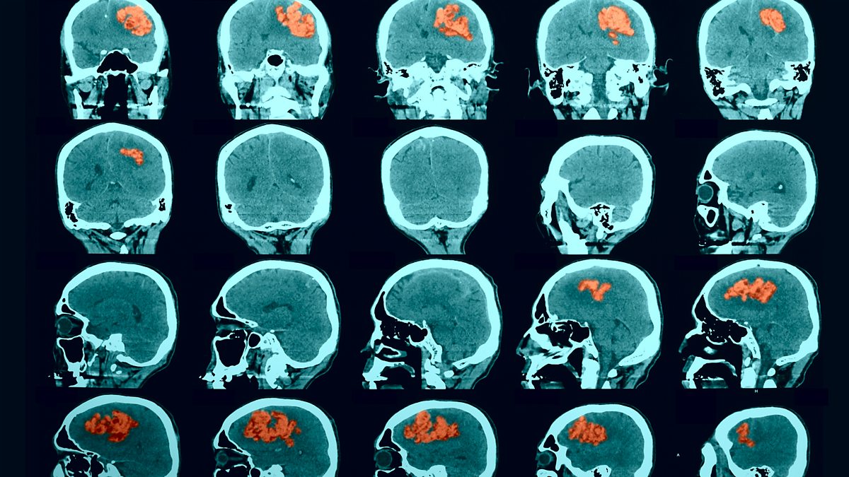 BBC World Service - Health Check, How to Spot a Deadly Bleed on the Brain