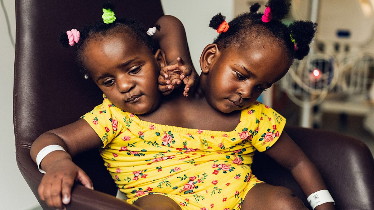 BBC Two The Conjoined Twins An Impossible Decision